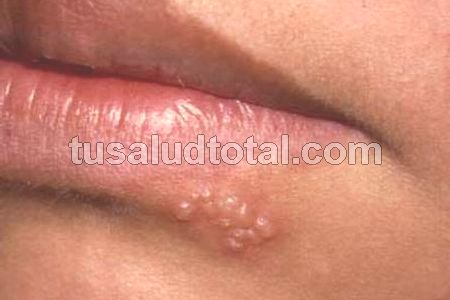 Causas del herpes labial