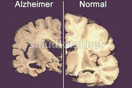 Ve aquí las fases del Alzheimer