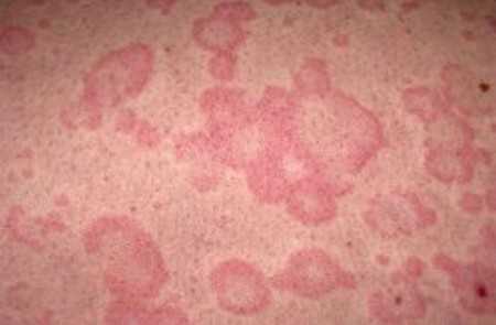 La urticaria causa manchas rojas en la piel