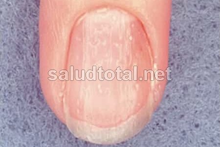 Conoce los síntomas de psoriasis en las uñas