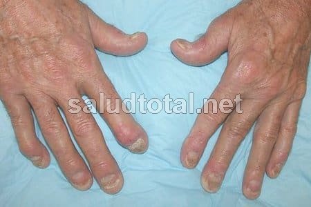 Ve aquí los síntomas de psoriasis reumatoide